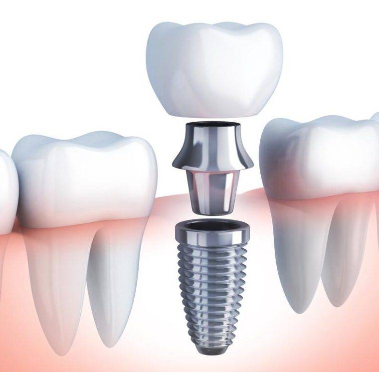 Implantes Dentários