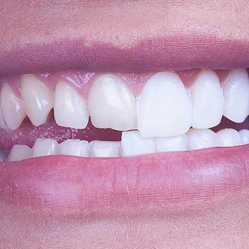 Facetas e estética dentária